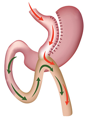 Bypass Gástrico de una Anastomosis BAGUA