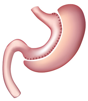 Manga Gástrica o Sleeve gastrectomy